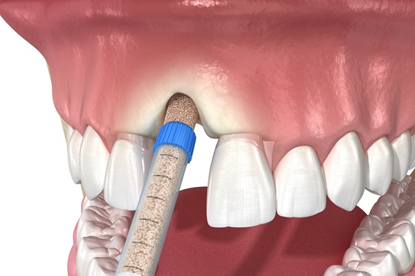 What You Should Know About Bone Grafting