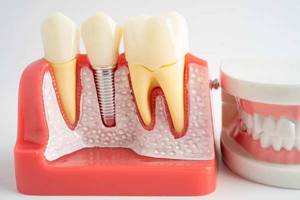 How Tooth Replacement Enhances Oral Health And Confidence